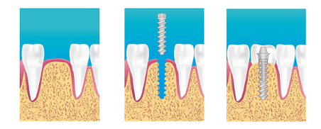 Implant dentaire Villepinte